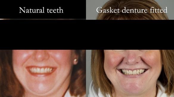Finlay's Newsletter 58 Gasket upper partial denture for Zoe