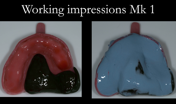 Figure 17 Alginate adhesive added. Dentsply Blueprint placed, glazed with running water and gloved finger.