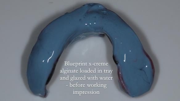 Finlay's Newsletter 59 Ultra hard partial dentures made for Gill