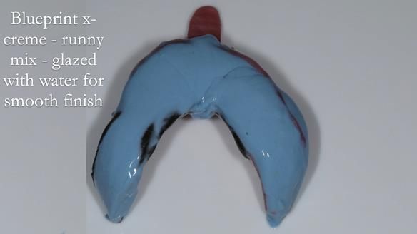 Newsletter 54 case presentation upper complete denture and lower Scandinavian designed hygienic partial denture for David