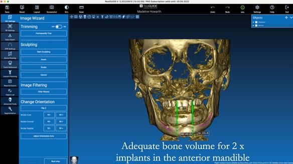 Replacing Madeline’s Complete denture FULL PROTOCOL
