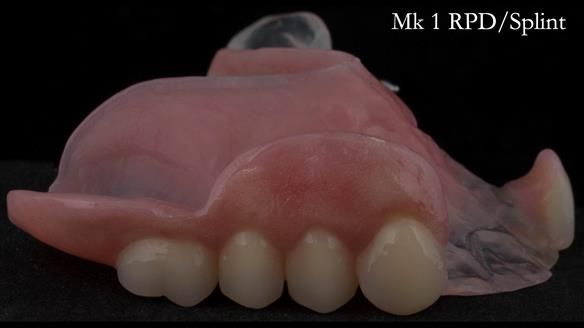 Newsletter 51 Managing Anne’s failing dentition with distal extension base RPD/Splint FULL PROTOCOL