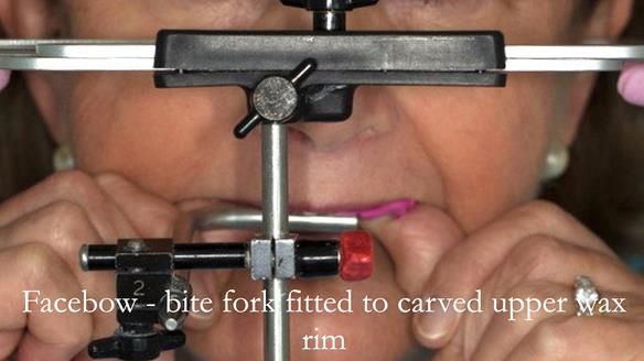 The face bow attached to the wax rim is used to mount the upper working cast on the articulator