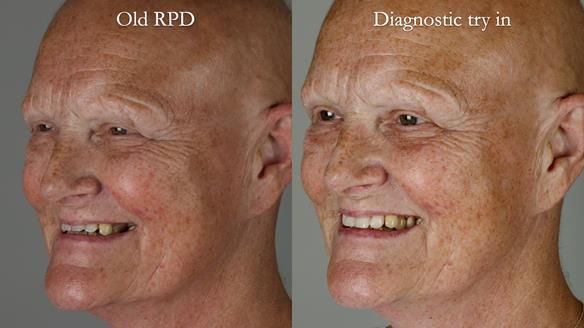 Newsletter 81 - Pam’s Story — how a partial denture changed her life (+ live walkthrough this Thursday)