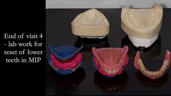 Newsletter 80 - Gordon’s dentures: the one case in 1,000 where my technique failed