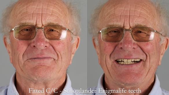 Complete denture Class II div 2 deep overbite Newsletter 39