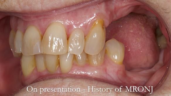 Finlay's Newsletter 60 Sylvia's upper Kennedy Class 2 Mod 1 metal based upper RPD