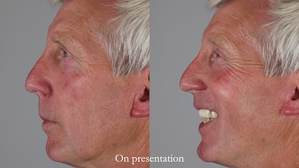 Newsletter 77: Jeremy’s case – immediate complete upper denture