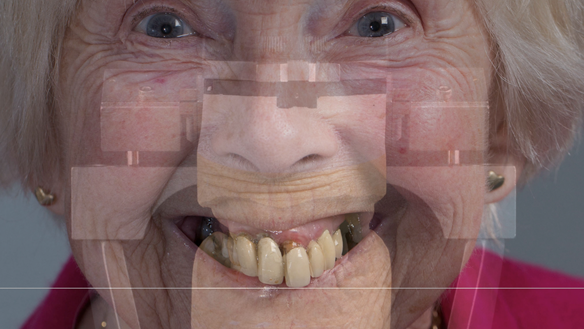 Figure 27 Ideal incisal plane translated to the mounted cast