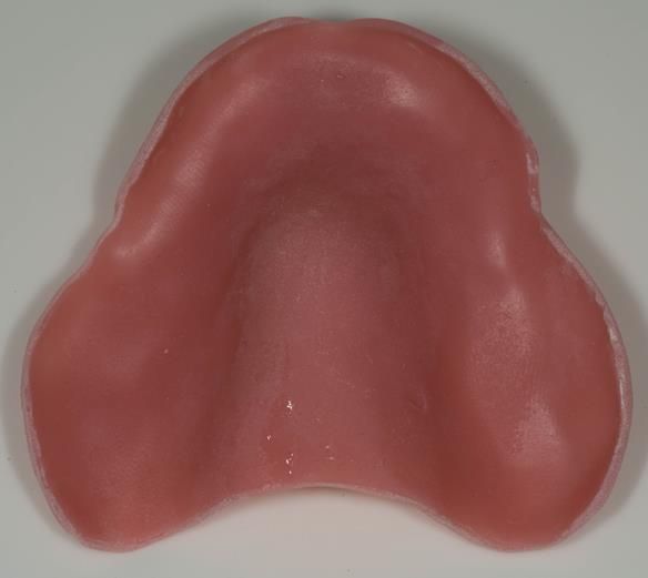 Figure 75 Maxillary spaced special tray for alginate