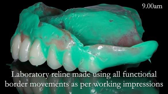 Newsletter 52 Managing Jo’s failing dentition with extractions and Mk 1/Mk 2 complete upper dentures and lower partial dentures FULL PROTOCOL