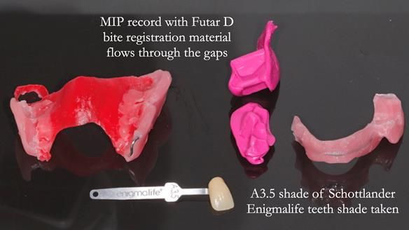 Finlay's Newsletter 60 Sylvia's upper Kennedy Class 2 Mod 1 metal based upper RPD