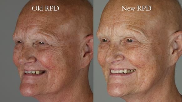 Newsletter 81 - Pam’s Story — how a partial denture changed her life (+ live walkthrough this Thursday)