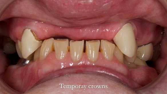 Newsletter 81 - Pam’s Story — how a partial denture changed her life (+ live walkthrough this Thursday)