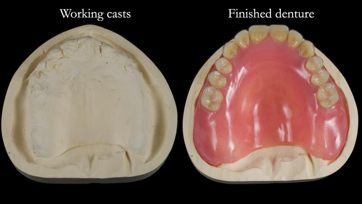 Fin’s Newsletter 88 — Complete dentures - full protocol… he rearranged his own teeth!