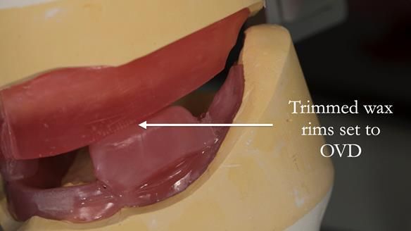 Newsletter 75: Marion’s case - Step-by-step complete denture workflow