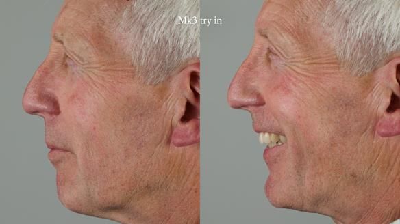 Newsletter 77: Jeremy’s case – immediate complete upper denture