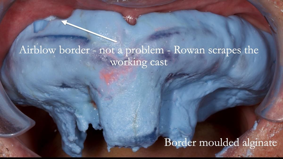 Fin’s Newsletter 88 — Complete dentures - full protocol… he rearranged his own teeth!