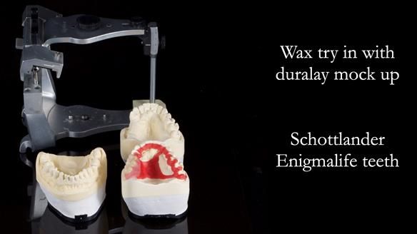 Finlay's Newsletter 64 case study - provision of a Kennedy class 2 metal based Scandinavian RPD for Ian