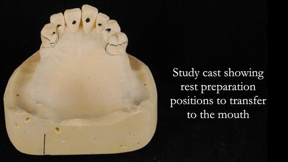 Newsletter 56 showing the making and fitting of a bilateral free end saddle upper removable partial denture (RPD) for patient with pemphigus
