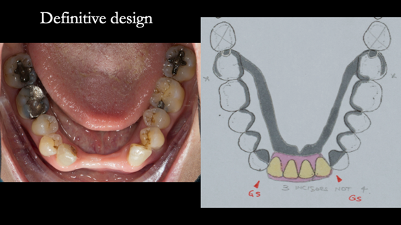 Figure 55 definitive lower denture design
