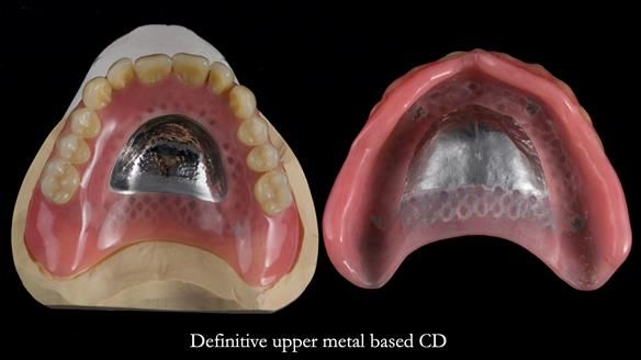 Newsletter 82 Mary - A complete upper and a one-tooth gasket denture