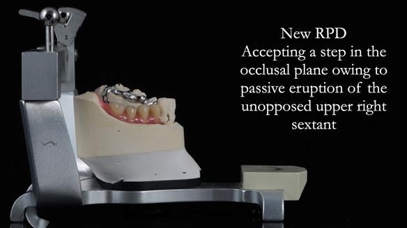 Finlay's Newsletter 61 provision of a lower unilateral free end saddle metal based partial denture for Joyce