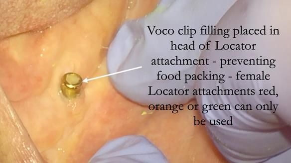 Managing poor implant positioning with complete dentures and Locator attachments - full protocol Newsletter 41