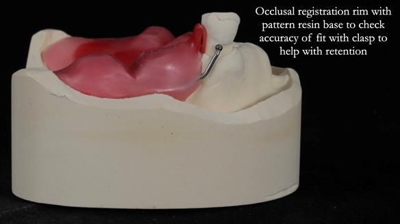 Newsletter 55 Provision of metal based partial dentures for Zephyrine with a repaired cleft lip and palate