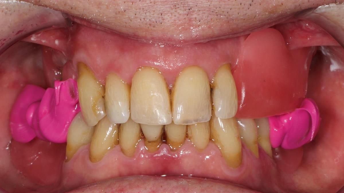 Newsletter 89 – Simon: A Challenging Kennedy Class II Division 1 Upper CoCr Partial Denture with a High Smile Line
