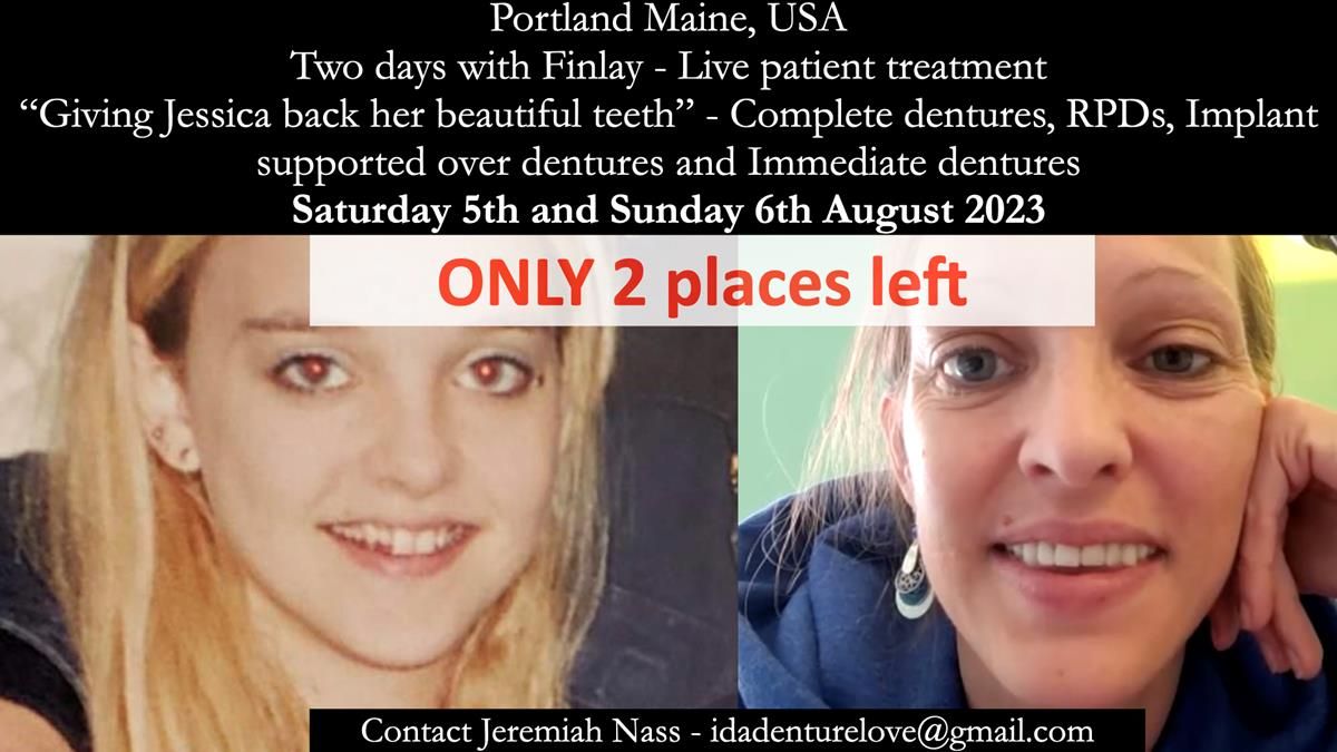 Newsletter 52 Managing Jo’s failing dentition with extractions and Mk 1/Mk 2 complete upper dentures and lower partial dentures FULL PROTOCOL