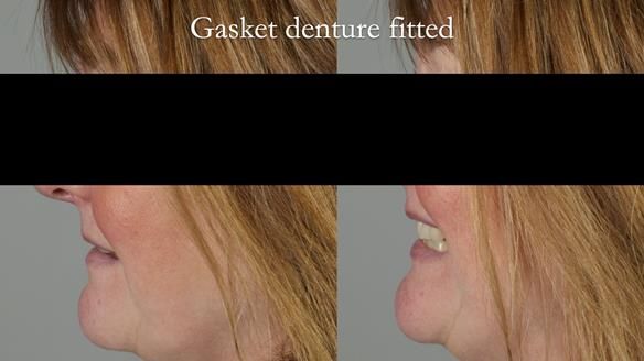 Finlay's Newsletter 58 Gasket upper partial denture for Zoe