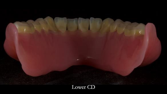 Newsletter 83: Sheila’s Complete Denture Success