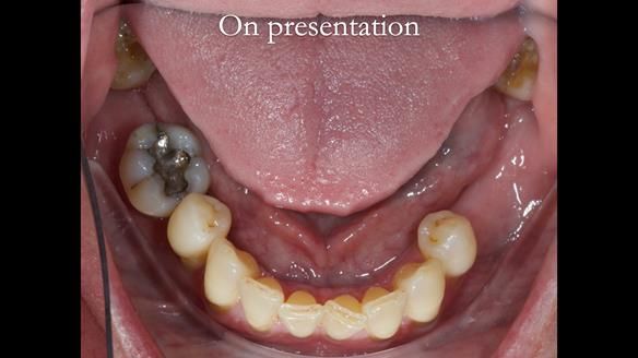Finlay's Newsletter 58 Gasket upper partial denture for Zoe