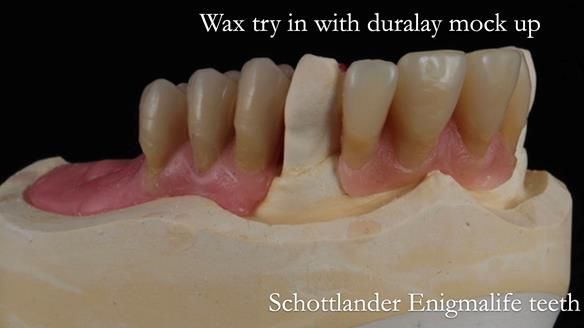 Finlay's Newsletter 59 Ultra hard partial dentures made for Gill