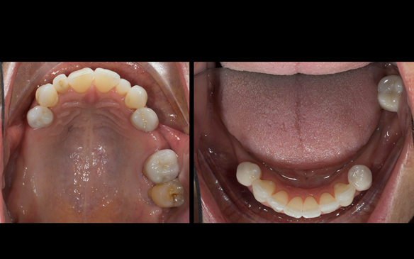 Figure 51 Porcelain fused to zirconia crown crowns incorporating parallel guiding surfaces, ledges and rest seats for the metal based partial dentures - fitted with Fuji plus cement.
