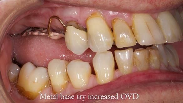 Finlay's Newsletter 64 case study - provision of a Kennedy class 2 metal based Scandinavian RPD for Ian