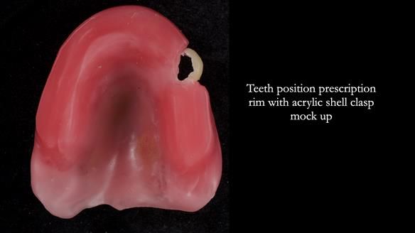 Newsletter 55 Provision of metal based partial dentures for Zephyrine with a repaired cleft lip and palate