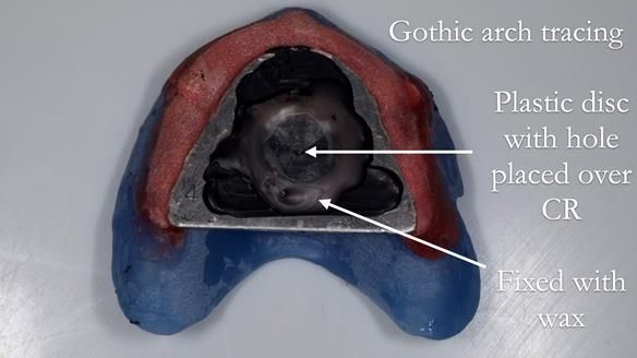 Newsletter 57 showcases the making and fitting process of implant-supported complete dentures for Alisdair