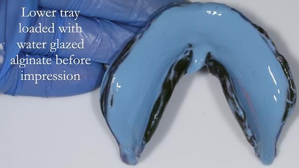 Newsletter 53 showing the making and fitting of ultra life-like dentures for Valena