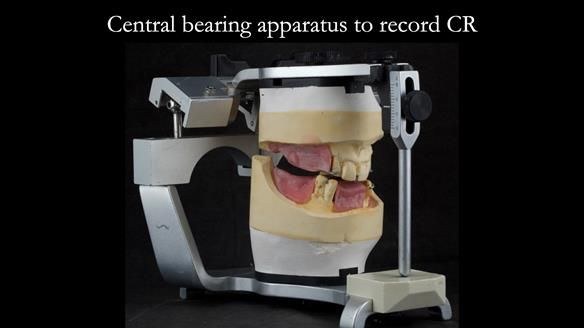 Finlay's Case Study Newsletter 40 - Immediate Mk 1 RPD to Definitive Mk 2 RPD - full protocol