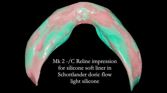 Replacing Madeline’s Complete denture FULL PROTOCOL