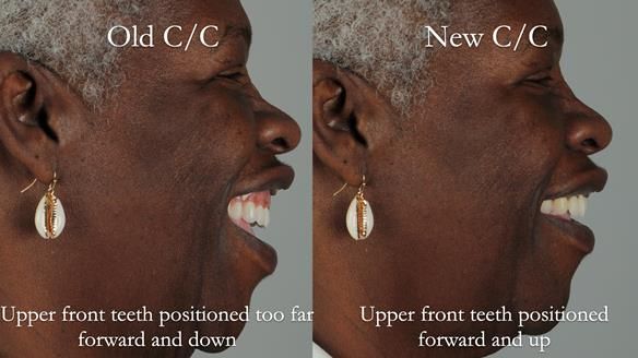 Newsletter 53 showing the making and fitting of ultra life-like dentures for Valena