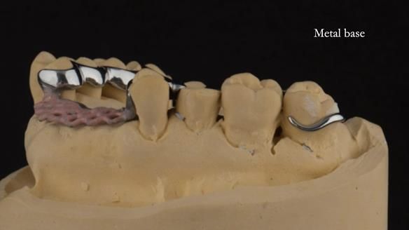 Finlay's Newsletter 63 Case study provision of metal based Scandinavian RPD - functional 10 years on