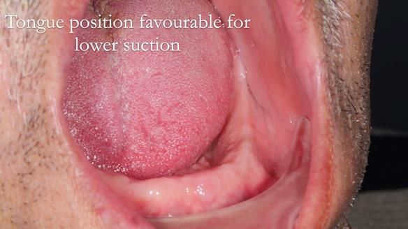 Finlay's Newsletter 62 provision of extractions and metal based complete dentures for Rafique