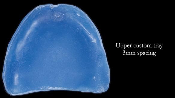Newsletter 83: Sheila’s Complete Denture Success