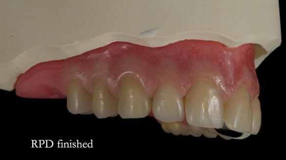 Newsletter 55 Provision of metal based partial dentures for Zephyrine with a repaired cleft lip and palate