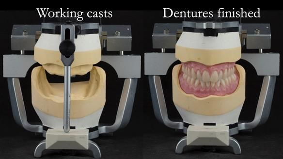 Newsletter 75: Marion’s case - Step-by-step complete denture workflow