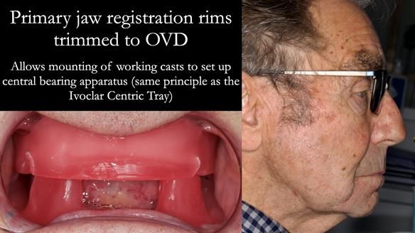 Newsletter 50 Special edition Complete Dentures FULL PROTOCOL