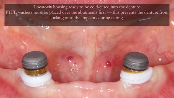 Newsletter 78: What do Clark Gable and a Locator® overdenture have in common?